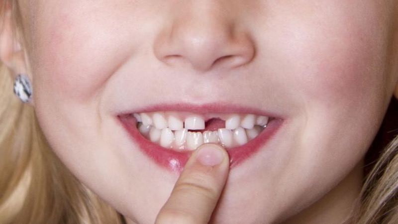 Giải mã chi tiết giấc mơ rụng răng